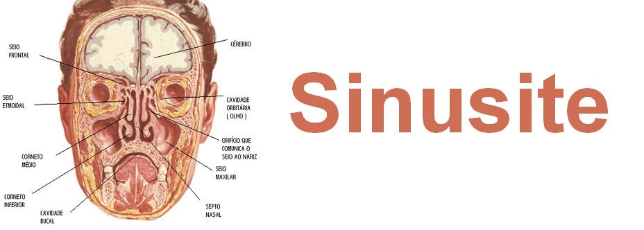 sinusite