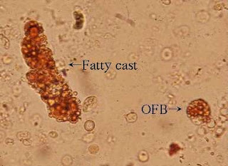 تحليل البول (4) Fatty+casts