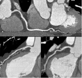 cardiac ct angiography indications
