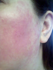 My Pretty Butterfly Rash #1