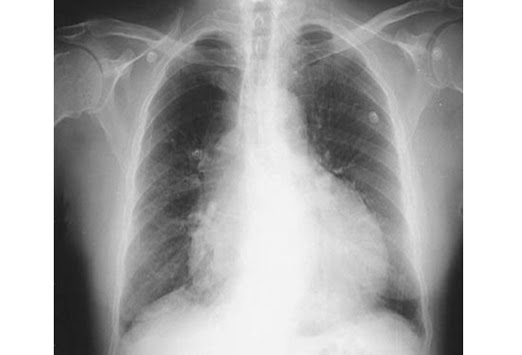 heart effusion Pulmonary effusion | definition of Pulmonary effusion by.