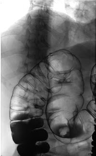ANGULO HEPATICO