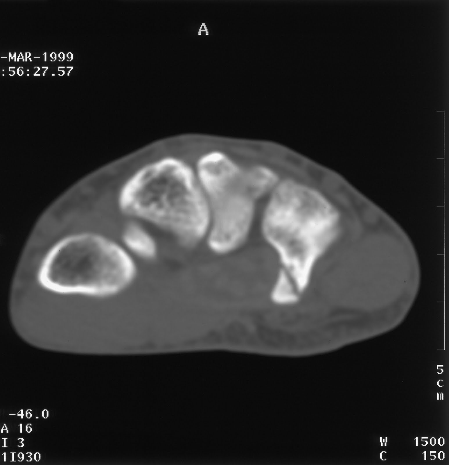 Non Displaced Fracture non+displaced+fracture+of+the+hamate.-4.bp.blogspot.com
