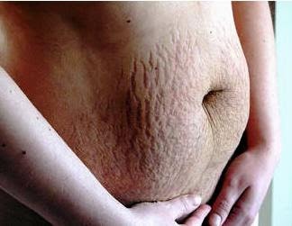 http://4.bp.blogspot.com/_sChV-E73tgU/SqPoji6UPpI/AAAAAAAAAL4/LsDSCdS0tf4/s400/stretch-mark-removal-men.jpg