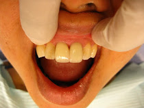 Improved Your Image With Full Ceramic Crowns Today!