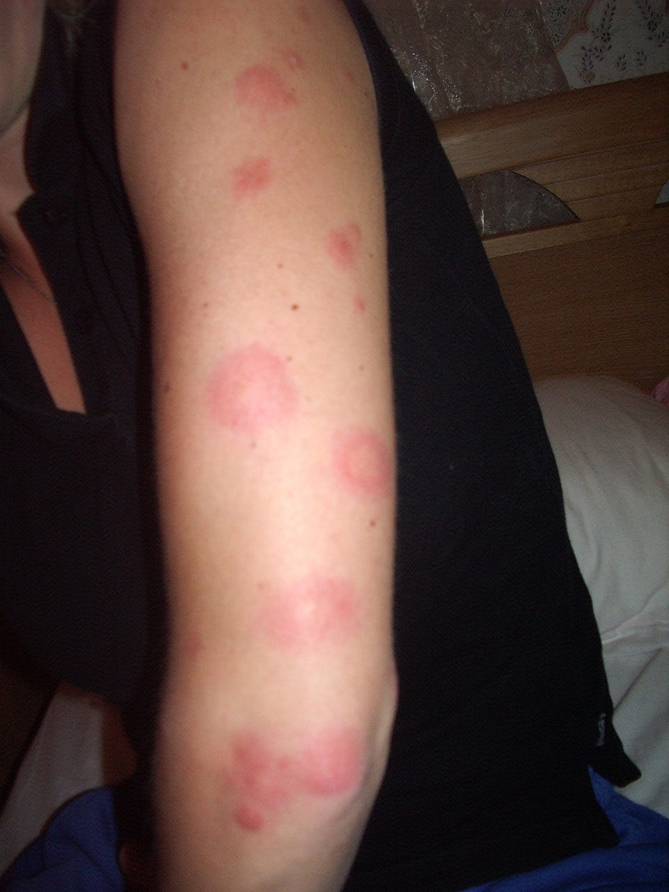 [Kelly's+bug+bites+001+(960x1280).jpg]