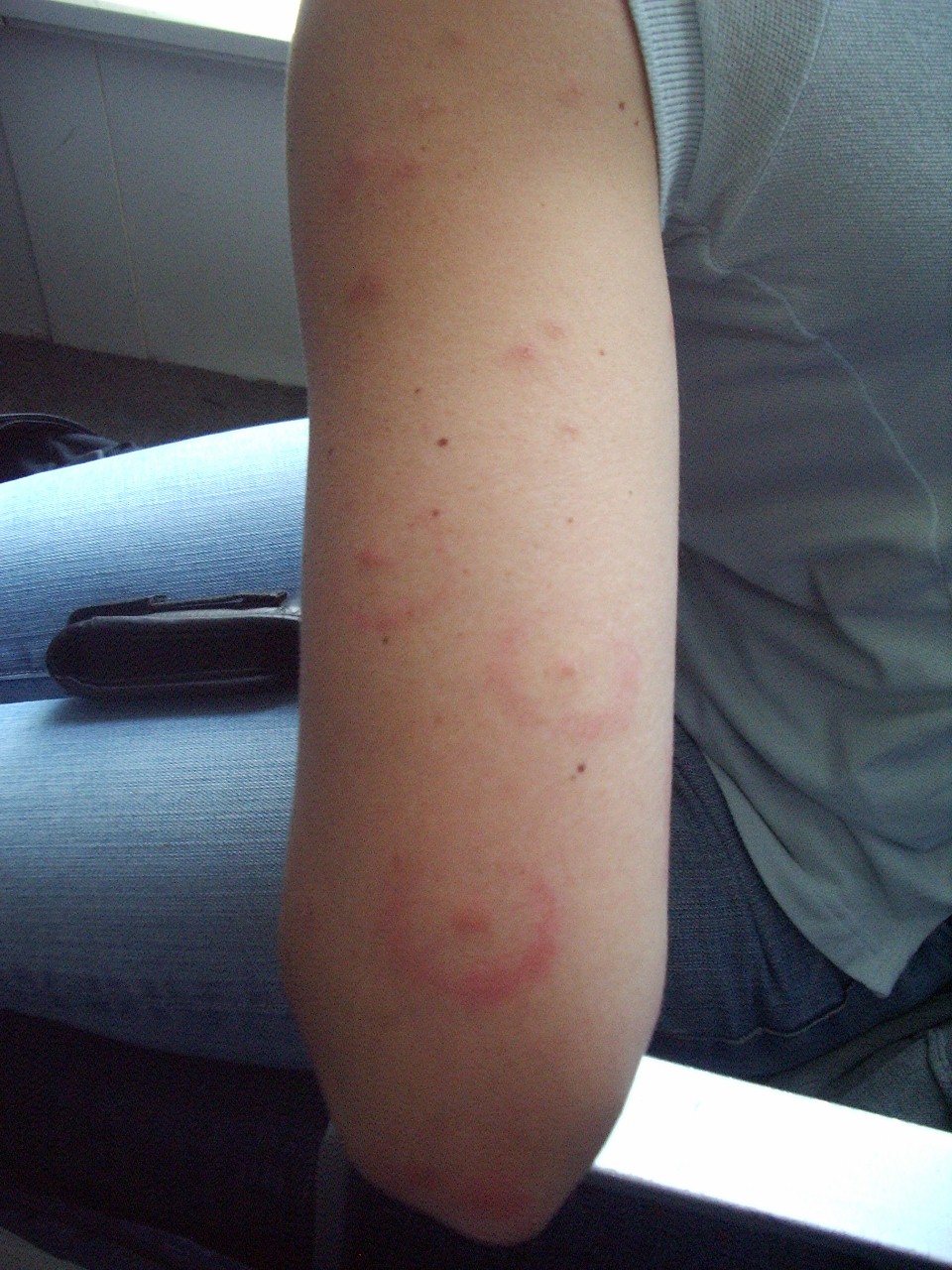 [Kelly's+bug+bites+009+(960x1280).jpg]