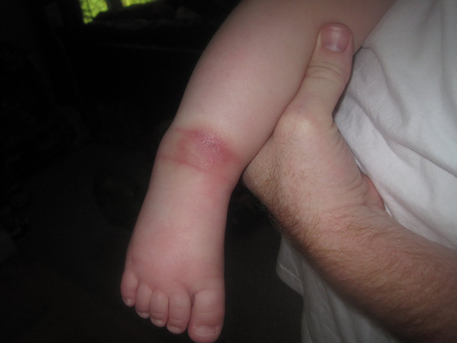 swollen ankle infection