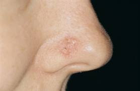 Skin Cancer Skin Cancer