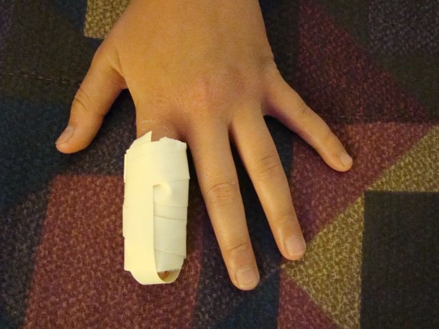 Finger Fracture Broken Finger-4.bp.blogspot.com