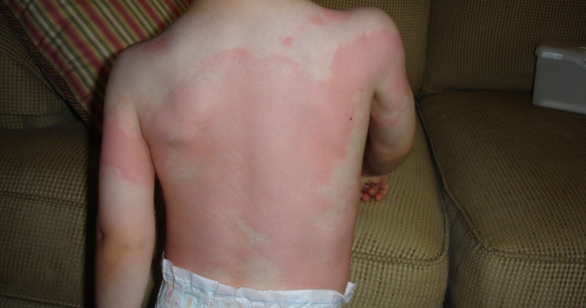 A Little Something Extra Mango allergy?