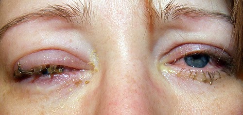 ögoninflammation ena ögat ögoninflammation ena ögat