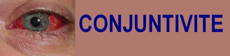 Conjuntivite