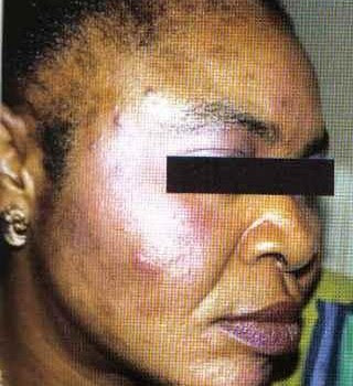 Folgen der HAUT-VERBLEICHUNG in AFRIKA