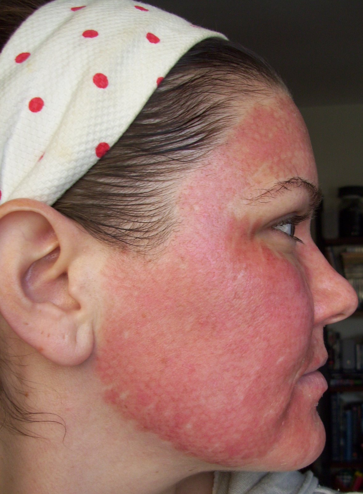[Post+Pearl+Day+2+Red+Beginning+Cheek+Chin.JPG]