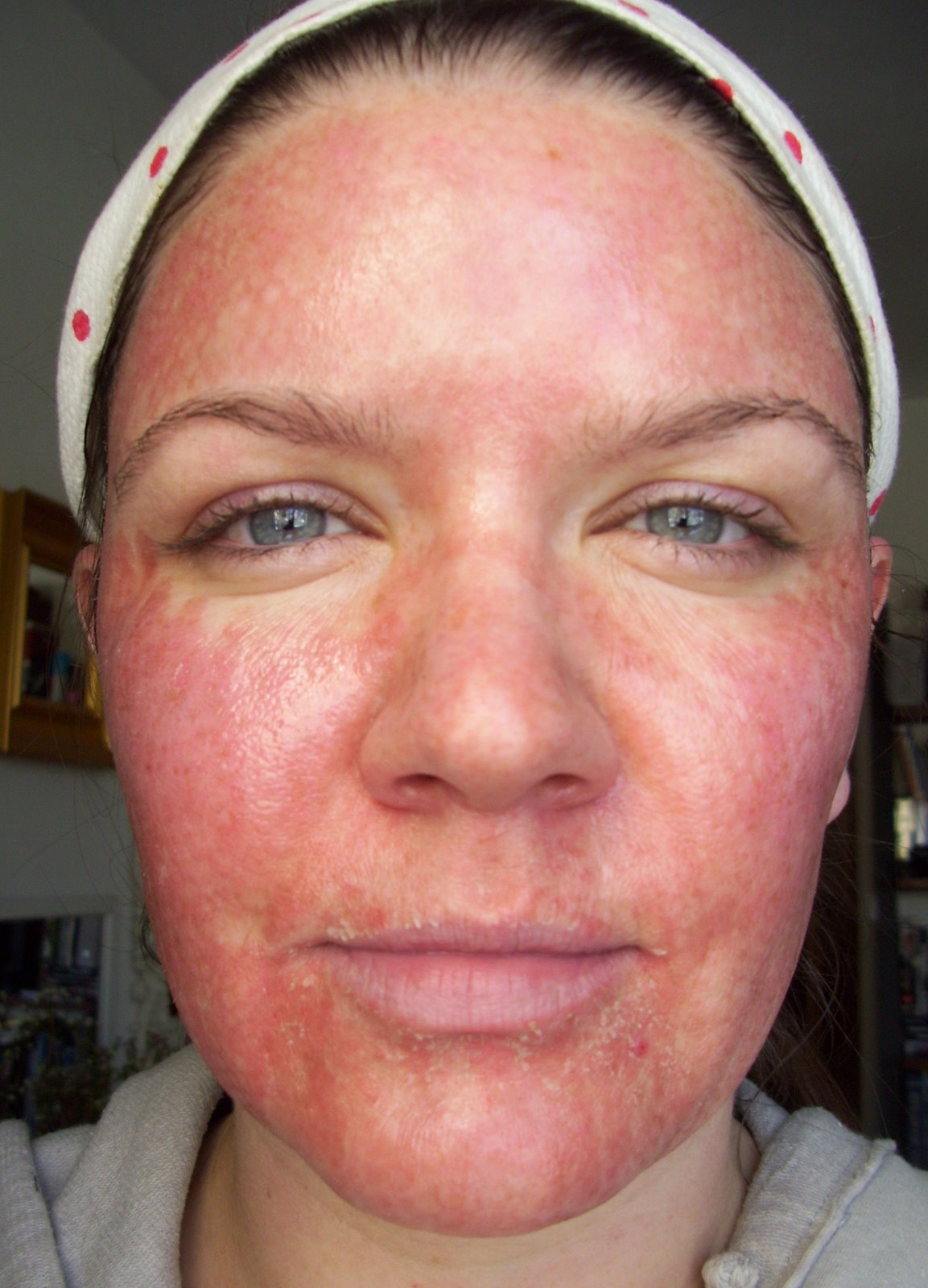 [Post+Pearl+Day+2+Red+Peeling+Full+Face.JPG]