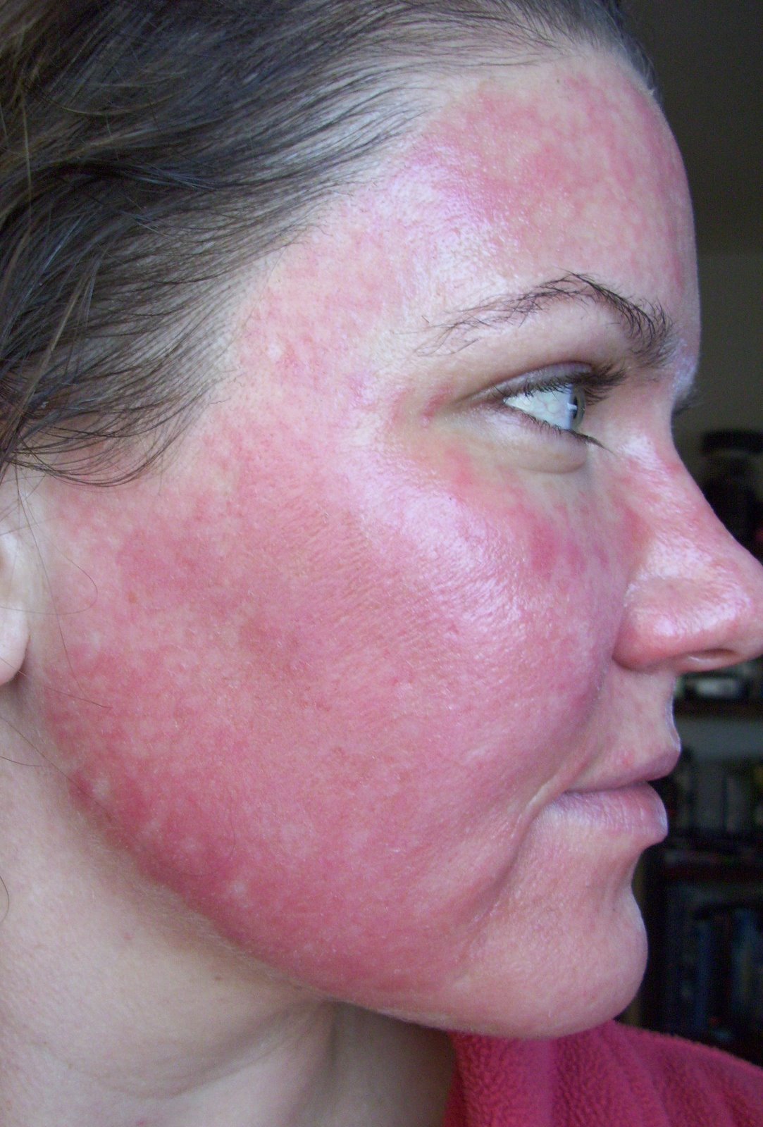 [Post+Pearl+Day+4+Red+Subsiding+Cheek.JPG]
