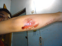 Sahabat, Memoriez, and All about Me..: Foto-Foto Gimana Luka di Tangan