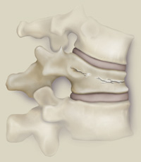 fractured_vertebra