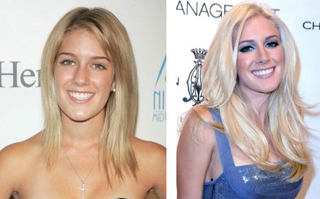 heidi montag before and after heidi montag before and after. heidi montag before and after