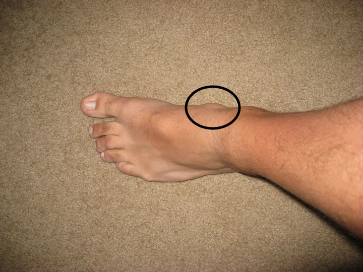 Ritchie's African Life Foot Saga Part 2