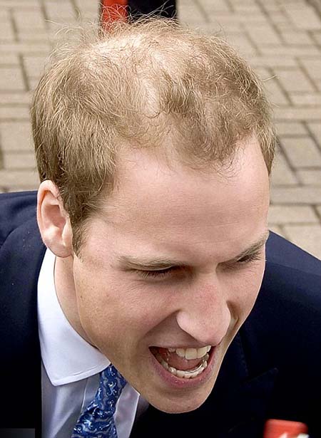 prince harry hair loss. men- Worried by hair loss