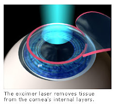 LASIK - LASER