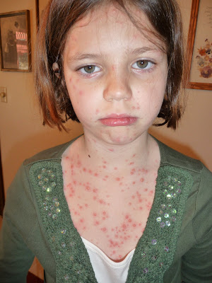 chicken pox. chicken pox baby.