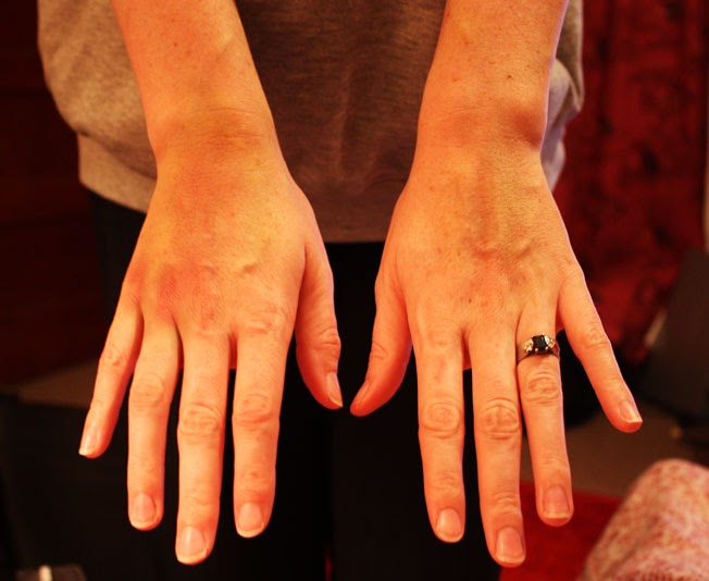 Kaitake Photos of my hands after 8 cannula attempts