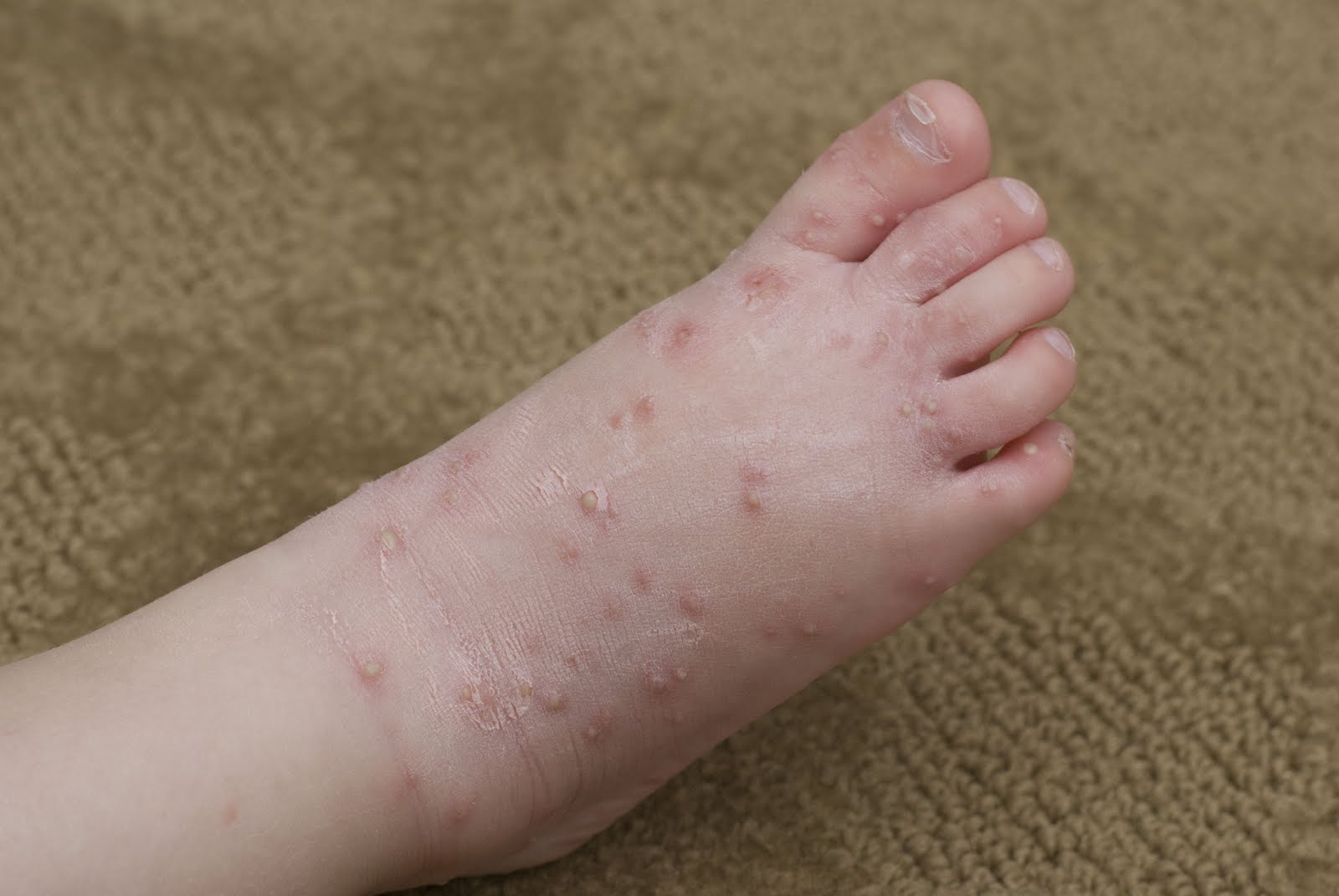 [Sadie+Ant+Bites.JPG]