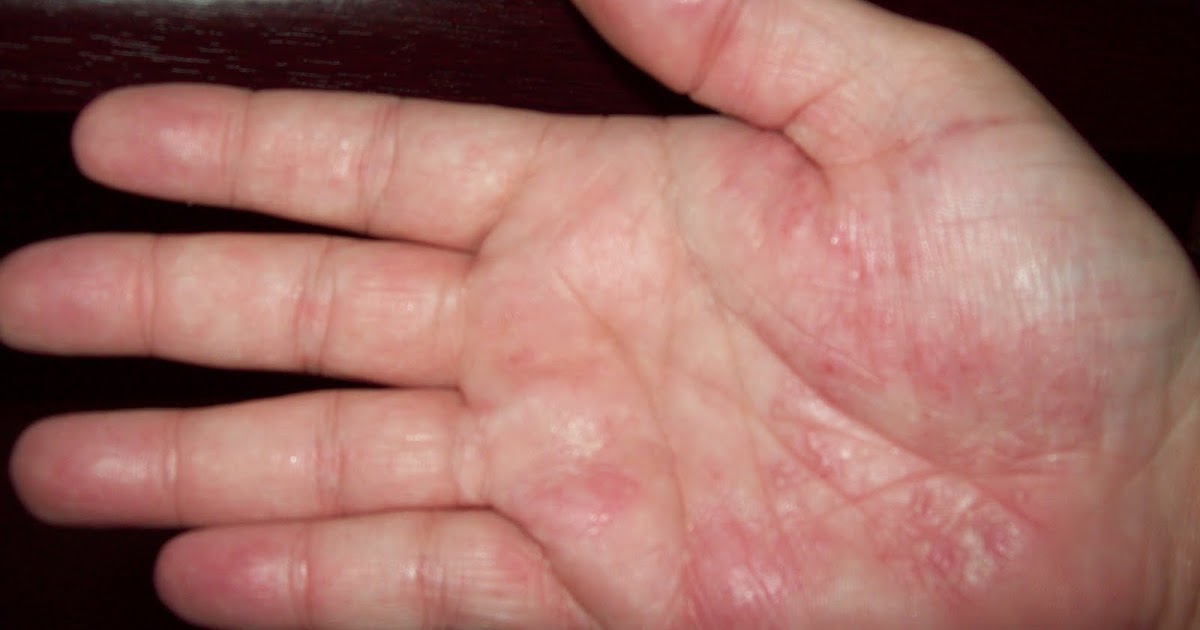 Life With PalmoPlantar Pustular Psoriasis Phew!