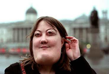 Victoria Wright Cherubism