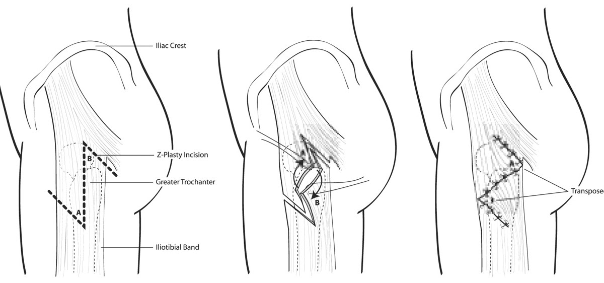 Madeline Sara 10 Days PostOp & Z Plastia