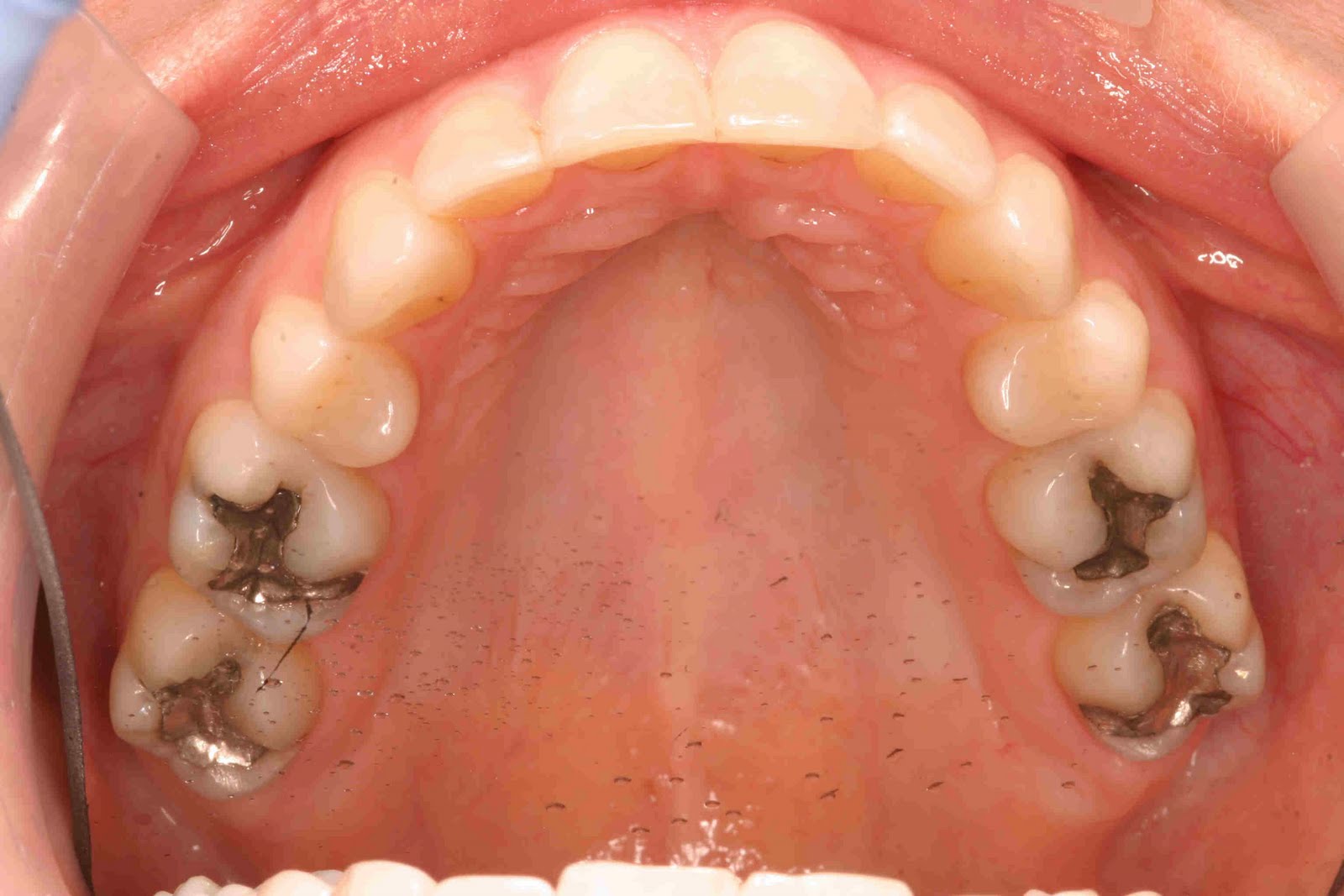 Austin Cosmetic Dentist Lakeway Dentist Dr Tejas Patel Austin