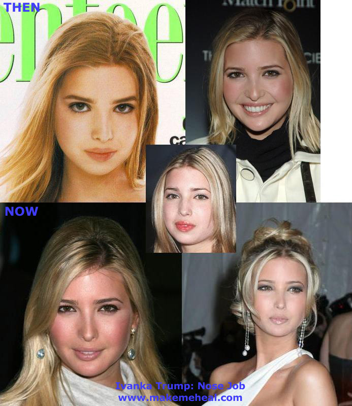 ivanka trump plastic surgery nose. Ivanka Trump#39;s nose job