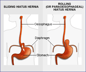 Radiology: Hiatus hern... Hourglass Stomach Sliding Hernia