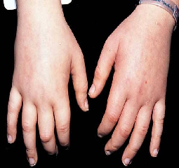 Natural Treatment For Fluid Around The Heart Natural Treatment For Fluid Around The Heart