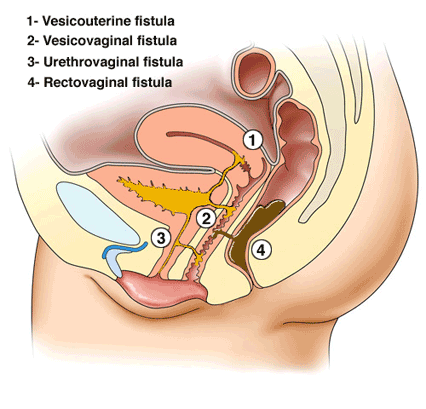 http://4.bp.blogspot.com/_uqHQrSVkLdk/S9vYJ8mX2KI/AAAAAAAAAPI/0Xm7w3N1fv0/s1600/fistulas.gif