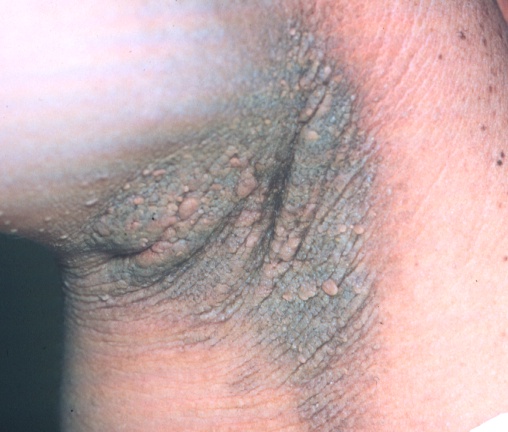 Acanthosis Nigricans?