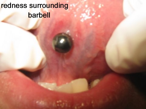 Extreme Tongue Piercing oral piercings. Extreme Tongue Piercing