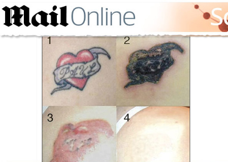 [rejuvi-creme-remove-tatuagens.jpg]