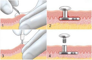 microdermal