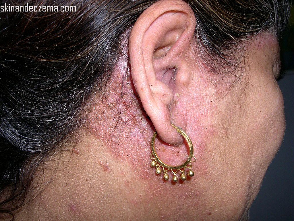 seborrheic dermatitis eczema
