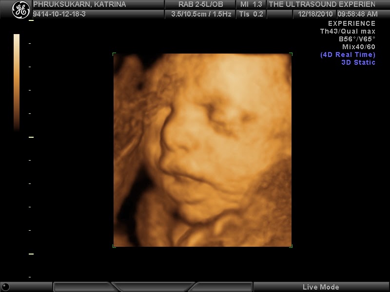 Baby Phruksukarn 4D Ultrasound Photos!!