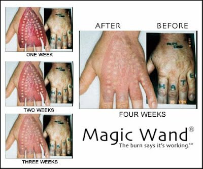 Magic Wand Home Tattoo Removal System. Tattoo Removal