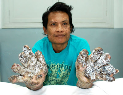 Dede the Indonesian Tree man dede tree man. Dede the Indonesian Tree man