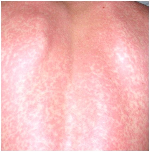 Vitamin B12 (Cyanocobalamin) deficiency causes white spots on the skin
