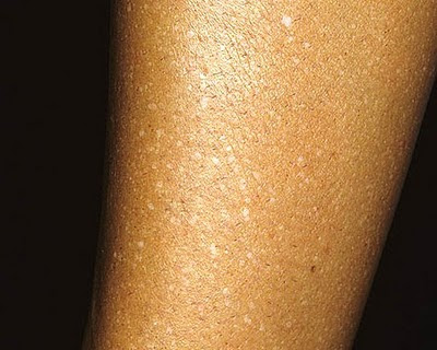 Idiopathic Guttate Hypomelanosis Cure Natural Idiopathic Guttate Hypomelanosis Cure Natural