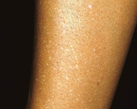 Idiopathic Guttate Hypomelanosis Cure Natural Idiopathic Guttate Hypomelanosis Cure Natural