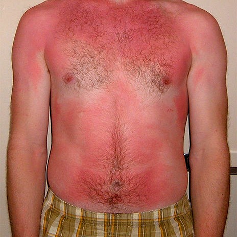 delayed sunburn reaction